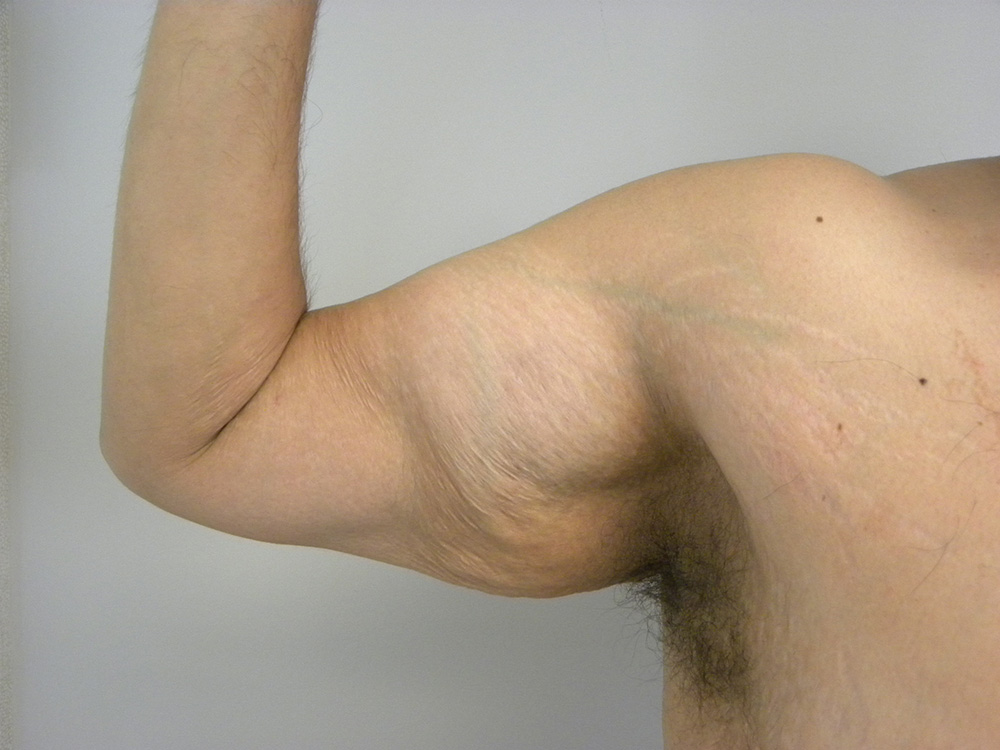 Arm Lift Before and After Pictures Miami, FL