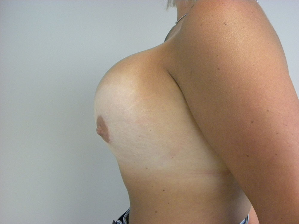 Revision Breast Augmentation Before and After Pictures in Miami, FL