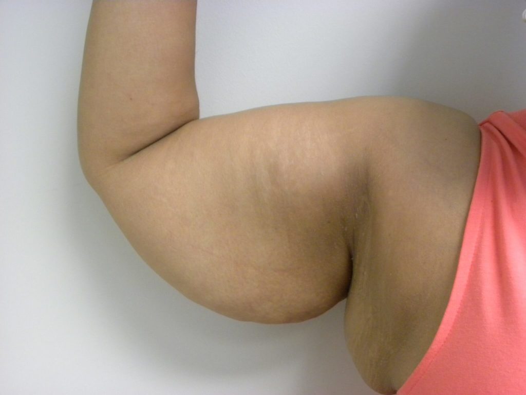 Arm Lift Before and After Pictures Miami, FL