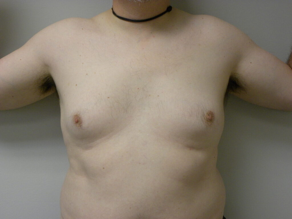 Plastic Surgery Before and After Pictures in Miami, FL - Dr. Adam J. Rubinstein 
