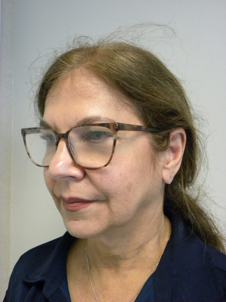 Neck Lift Before and After Pictures Miami, FL
