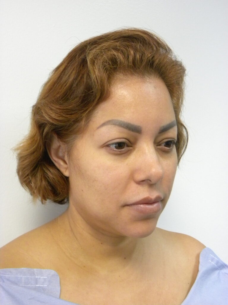 MINIMALLY INVASIVE NECK LIFT WITH ELLEVATE BEFORE AND AFTER PICTURES IN MIAMI, FL