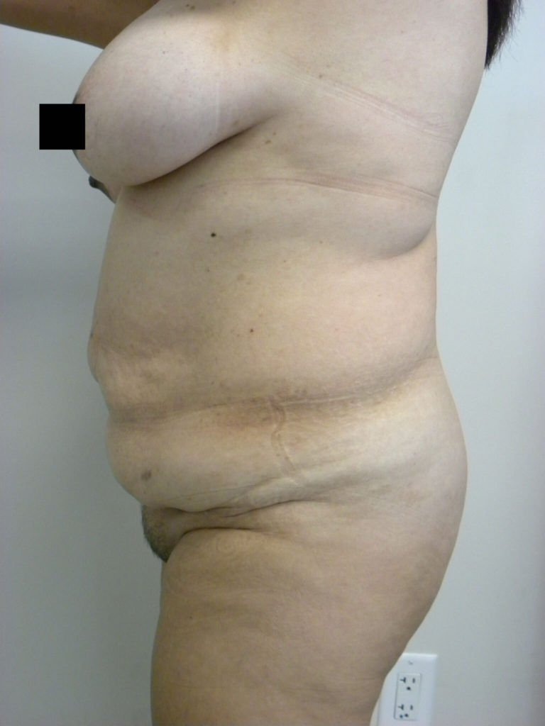 Tummy Tuck Before and After Pictures in Miami, FL