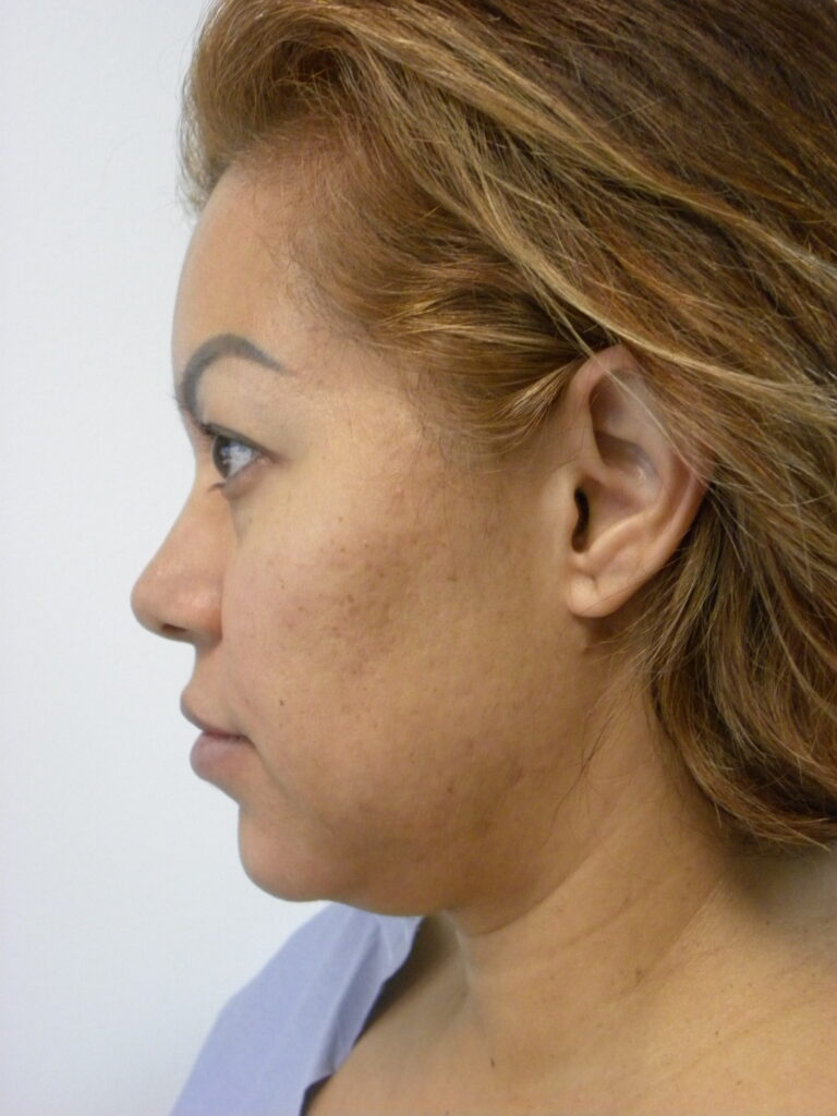 MINIMALLY INVASIVE NECK LIFT WITH ELLEVATE BEFORE AND AFTER PICTURES IN MIAMI, FL