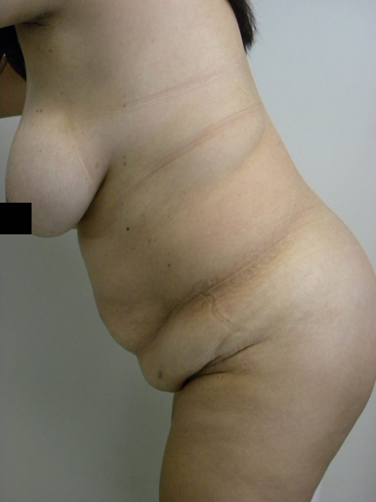 Tummy Tuck Before and After Pictures in Miami, FL