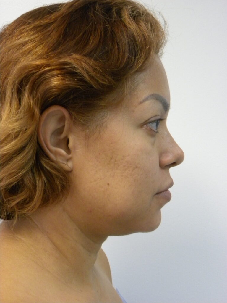 MINIMALLY INVASIVE NECK LIFT WITH ELLEVATE BEFORE AND AFTER PICTURES IN MIAMI, FL