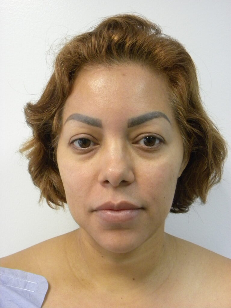 Plastic Surgery Before and After Pictures in Miami, FL - Dr. Adam J. Rubinstein 