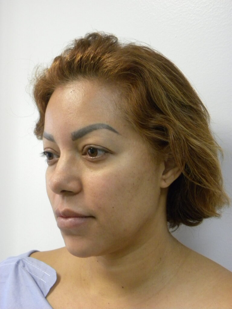 Plastic Surgery Before and After Pictures in Miami, FL - Dr. Adam J. Rubinstein 