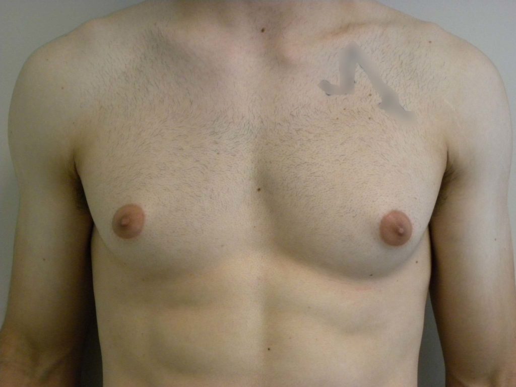 Gynecomastia Before and After Pictures in Miami, FL
