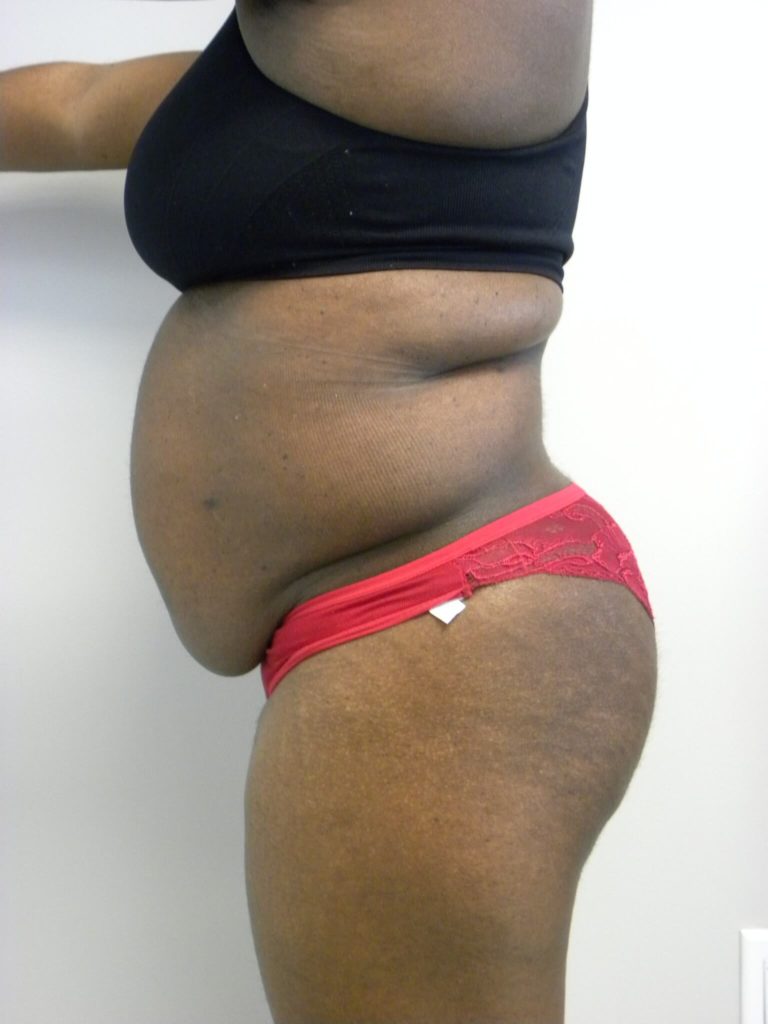 Tummy Tuck Before and After Pictures Miami, FL