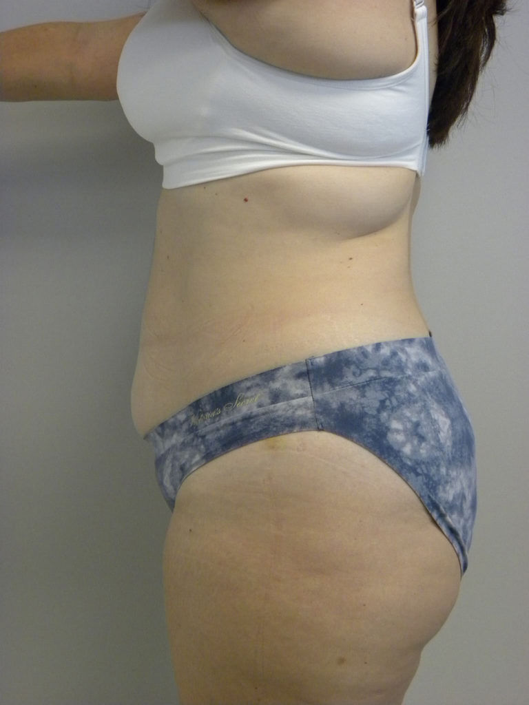 Tummy Tuck Before and After Pictures Miami, FL