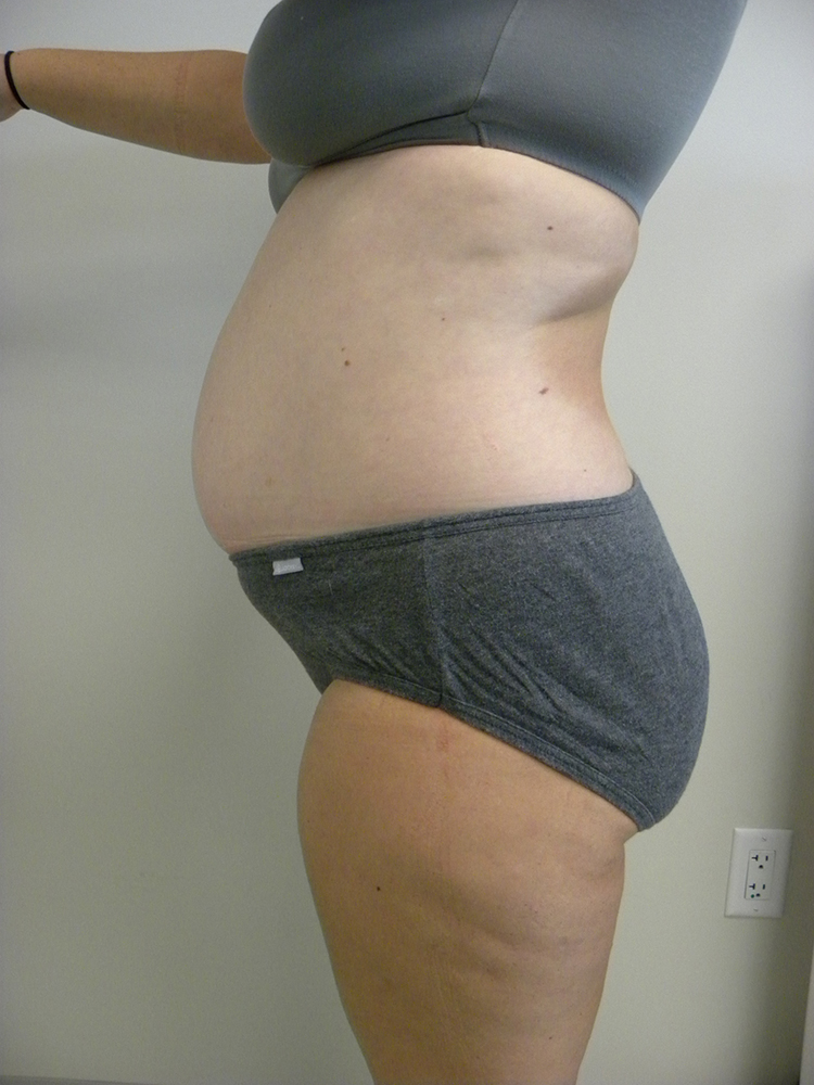 Tummy Tuck Before and After Pictures in Miami, FL