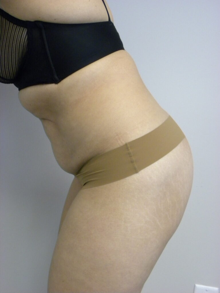 TUMMY TUCK BEFORE AND AFTER PICTURES IN MIAMI, FL