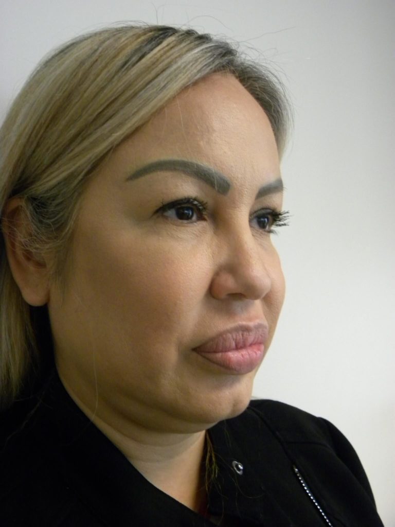 Neck Lift Before and After Pictures Miami, FL