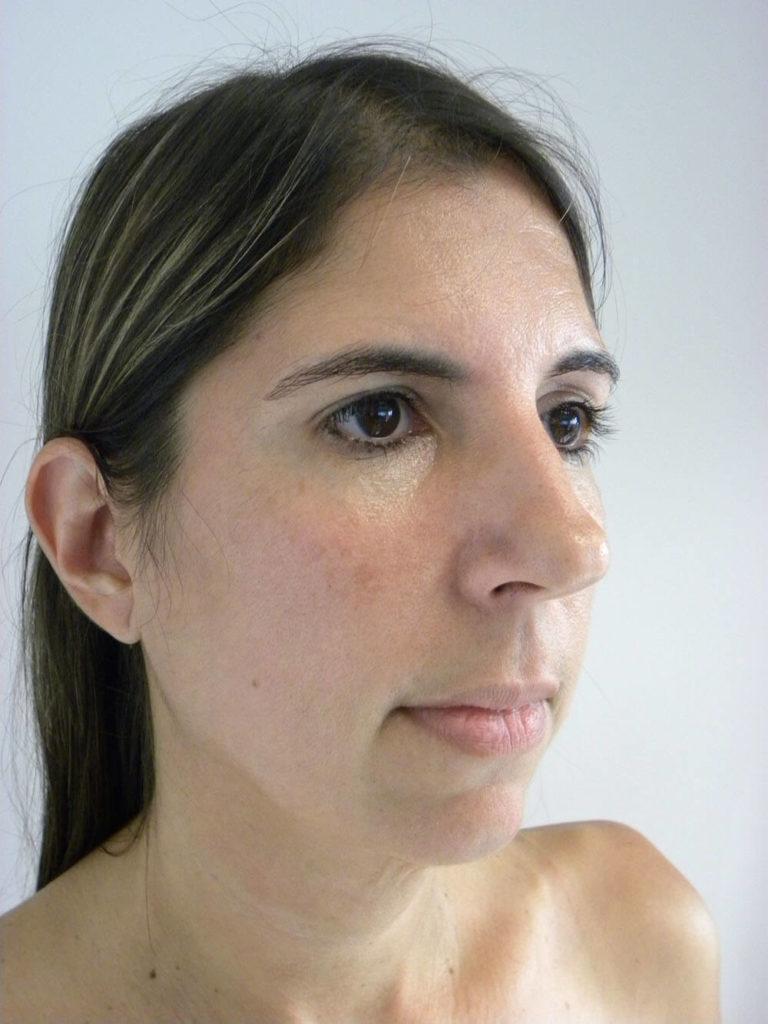 Neck Lift Before and After Pictures Miami, FL