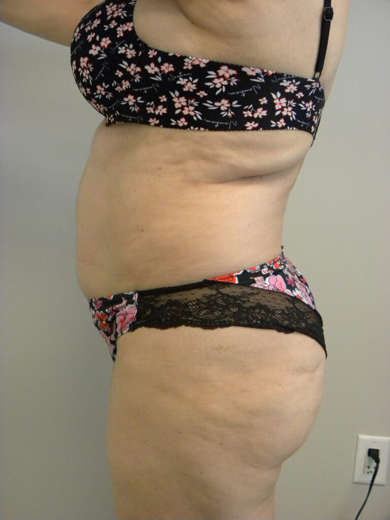 LIPOSUCTION BEFORE AND AFTER PICTURES IN MIAMI, FL