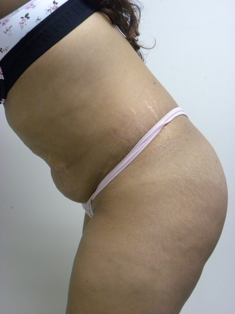 Tummy Tuck Before and After Pictures in Miami, FL