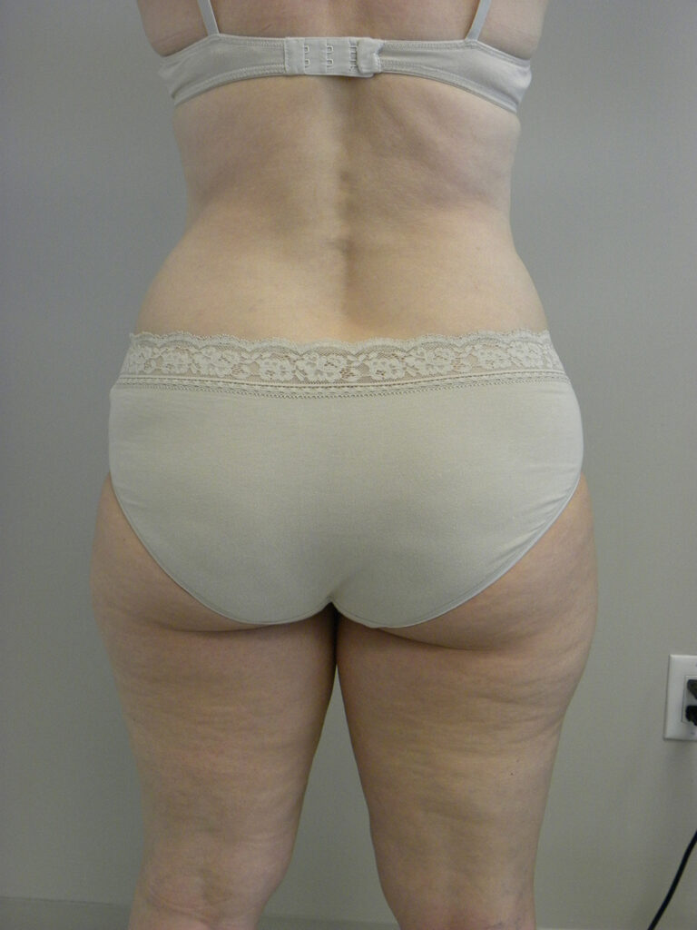 LIPOSUCTION BEFORE AND AFTER PICTURES IN MIAMI, FL