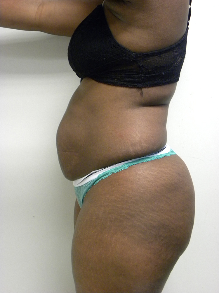 Tummy Tuck Before and After Pictures in Miami, FL