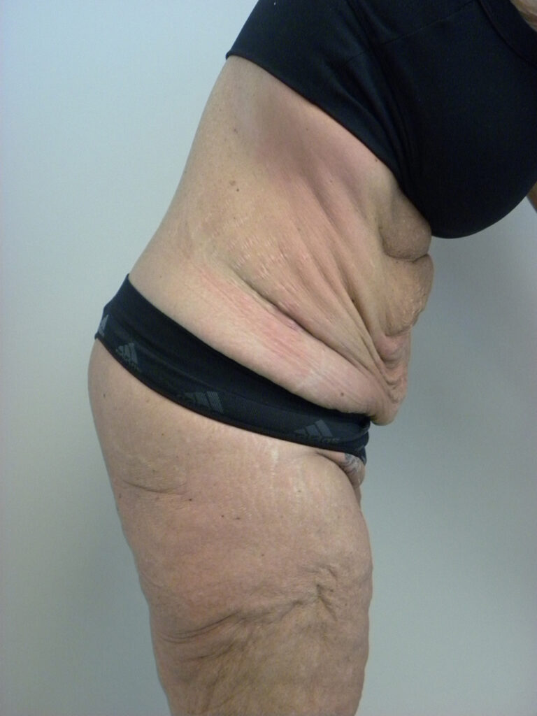 Tummy Tuck Before and After Pictures in Miami, FL