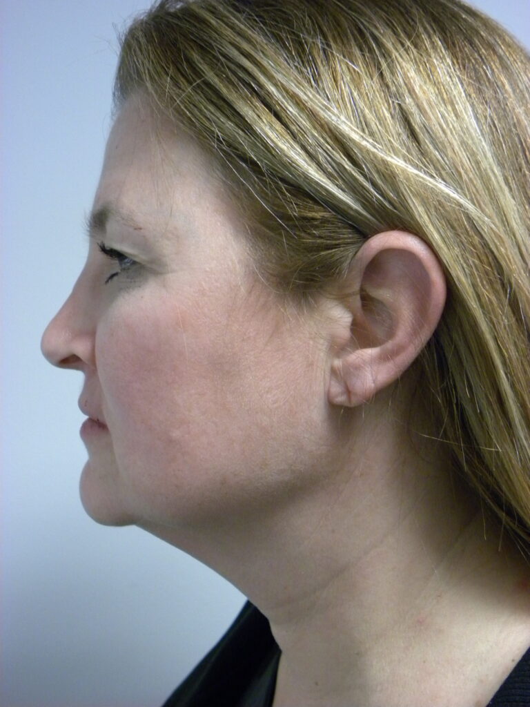 Minimally Invasive Neck Lift with Ellevate Before and After Pictures Miami, FL