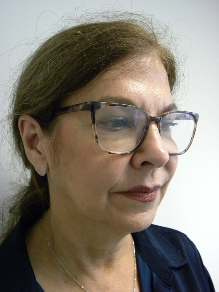 Neck Lift Before and After Pictures Miami, FL