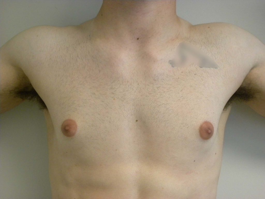 Gynecomastia Before and After Pictures in Miami, FL