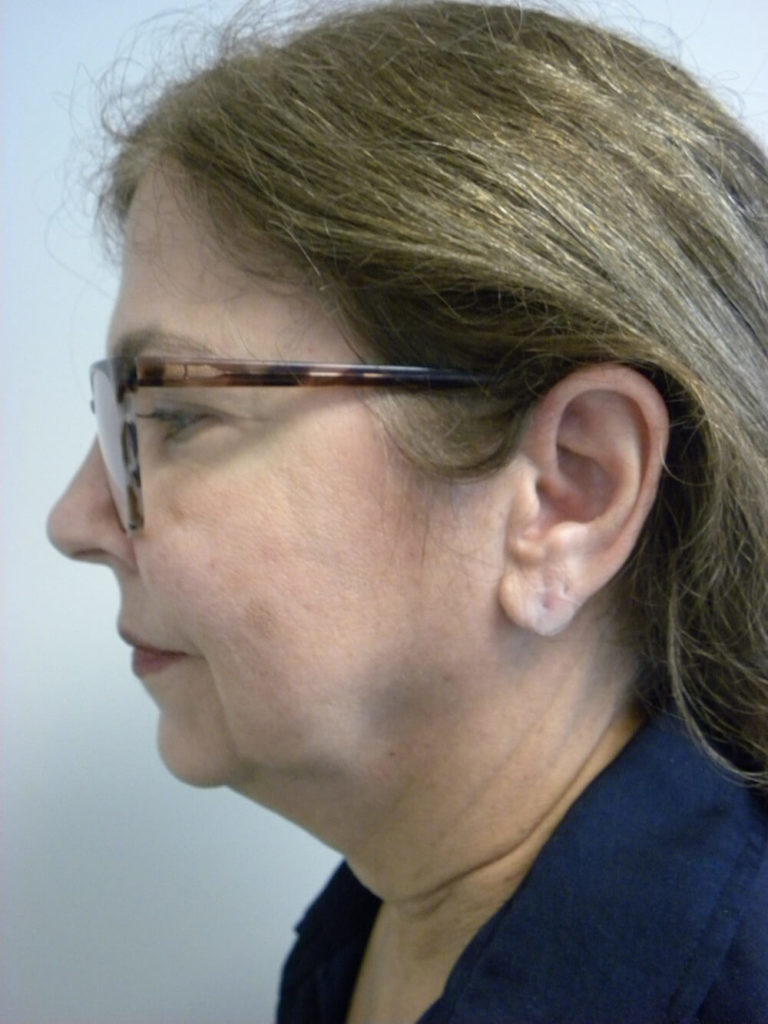 Neck Lift Before and After Pictures Miami, FL