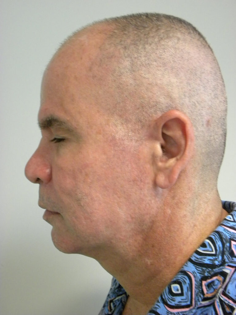 Neck Lift Before and After Pictures Miami, FL