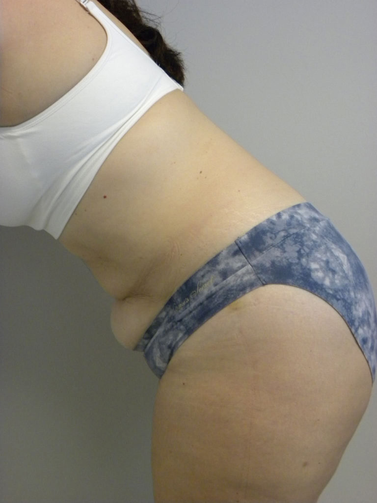 Tummy Tuck Before and After Pictures Miami, FL