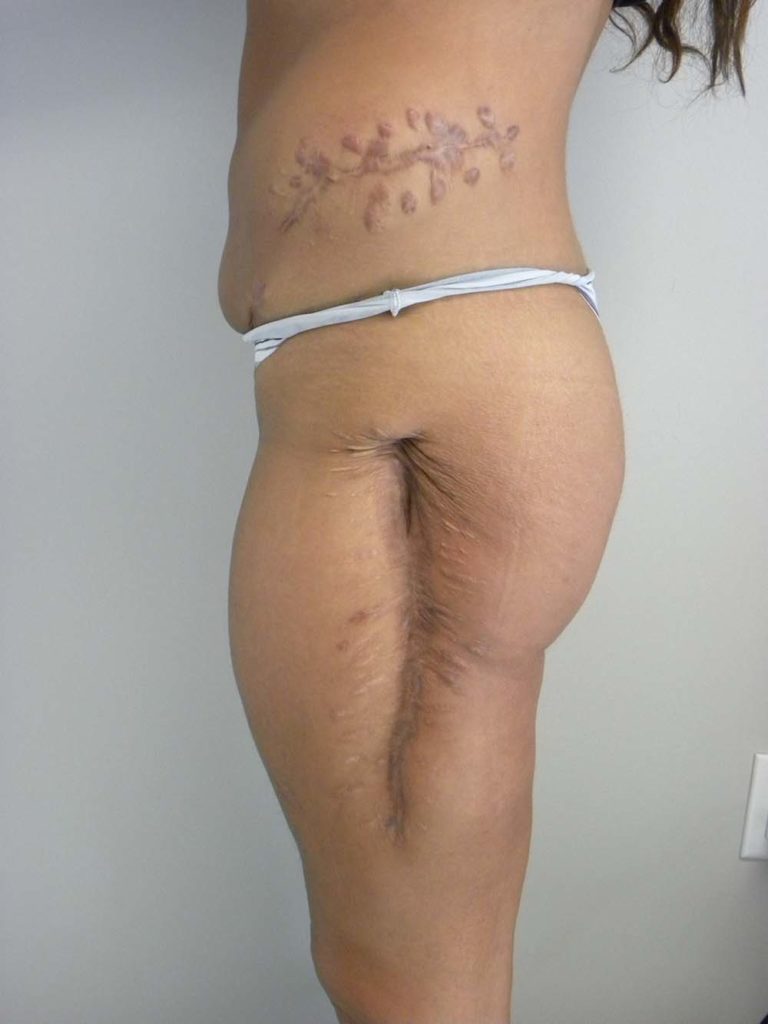 Scar Revision Before and After Pitcures in Miami, FL