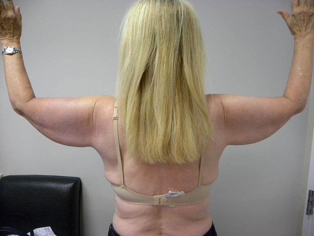 Arm Lift Before and After Pictures Miami, FL