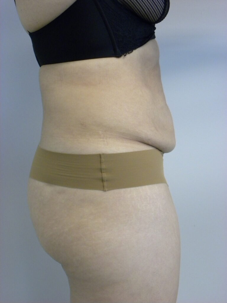 TUMMY TUCK BEFORE AND AFTER PICTURES IN MIAMI, FL