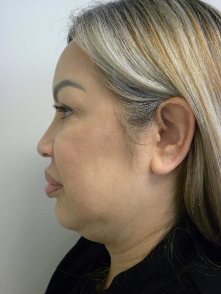 Minimally Invasive Neck Lift with Ellevate Before and After Pictures Miami, FL