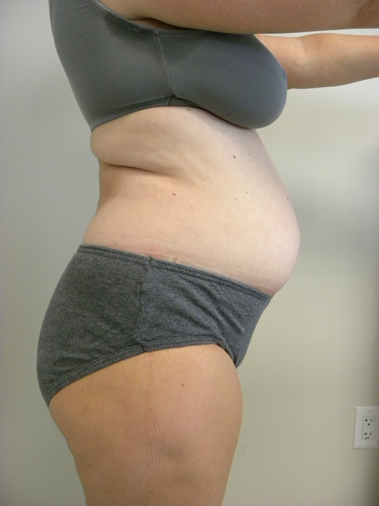 Tummy Tuck Before and After Pictures in Miami, FL