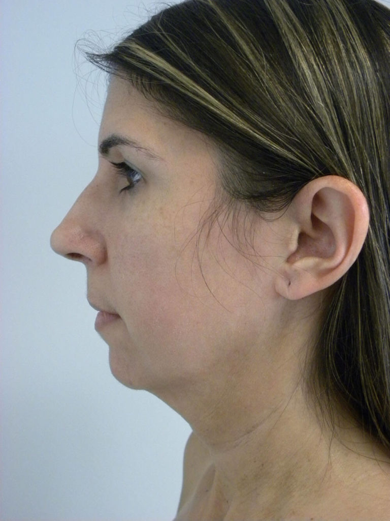 CHIN IMPLANT BEFORE AND AFTER PICTURES IN MIAMI, FL