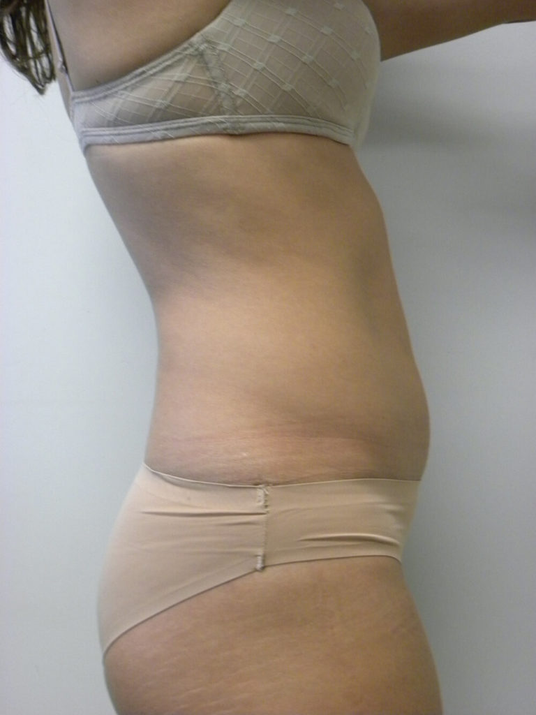 LIPOSUCTION BEFORE AND AFTER PICTURES IN MIAMI, FL