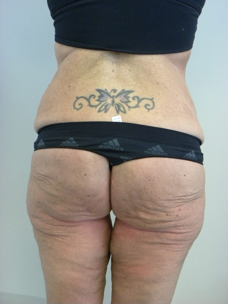 Tummy Tuck Before and After Pictures in Miami, FL