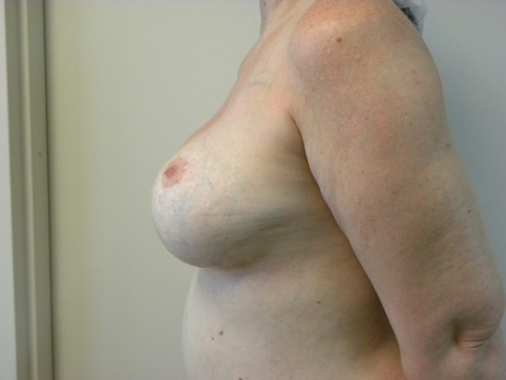 Revision Breast Augmentation Before and After Pictures Miami, FL