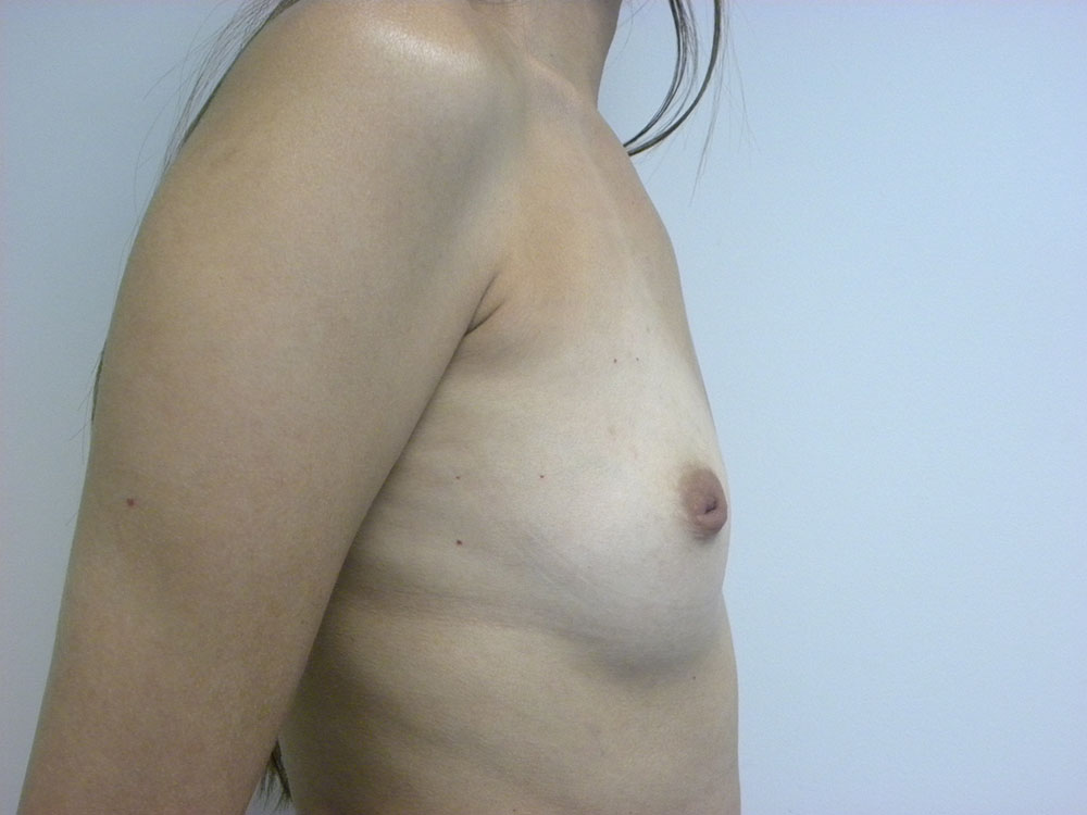 BREAST AUGMENTATION BEFORE AND AFTER PICTURES IN MIAMI, FL