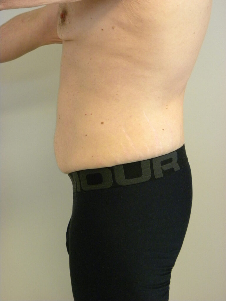 Plastic Surgery Before and After Pictures in Miami, FL - Dr. Adam J. Rubinstein 
