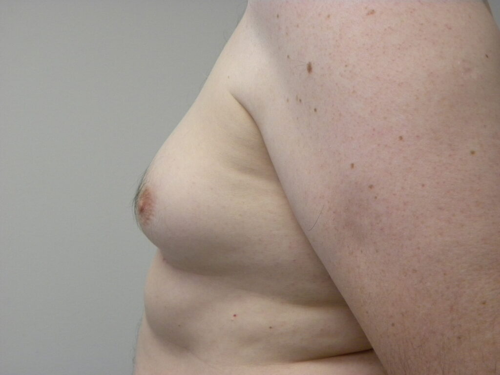 Plastic Surgery Before and After Pictures in Miami, FL - Dr. Adam J. Rubinstein 