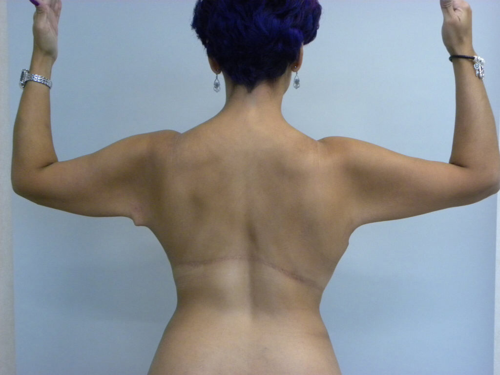 Plastic Surgery Before and After Pictures in Miami, FL - Dr. Adam J. Rubinstein 