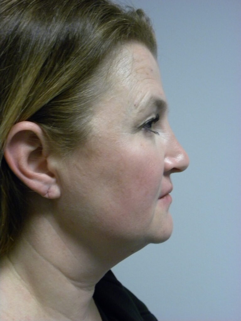 Plastic Surgery Before and After Pictures in Miami, FL - Dr. Adam J. Rubinstein 