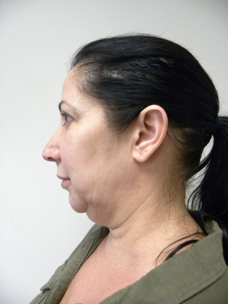 Minimally Invasive Neck Lift with Ellevate Before and After Pictures Miami, FL