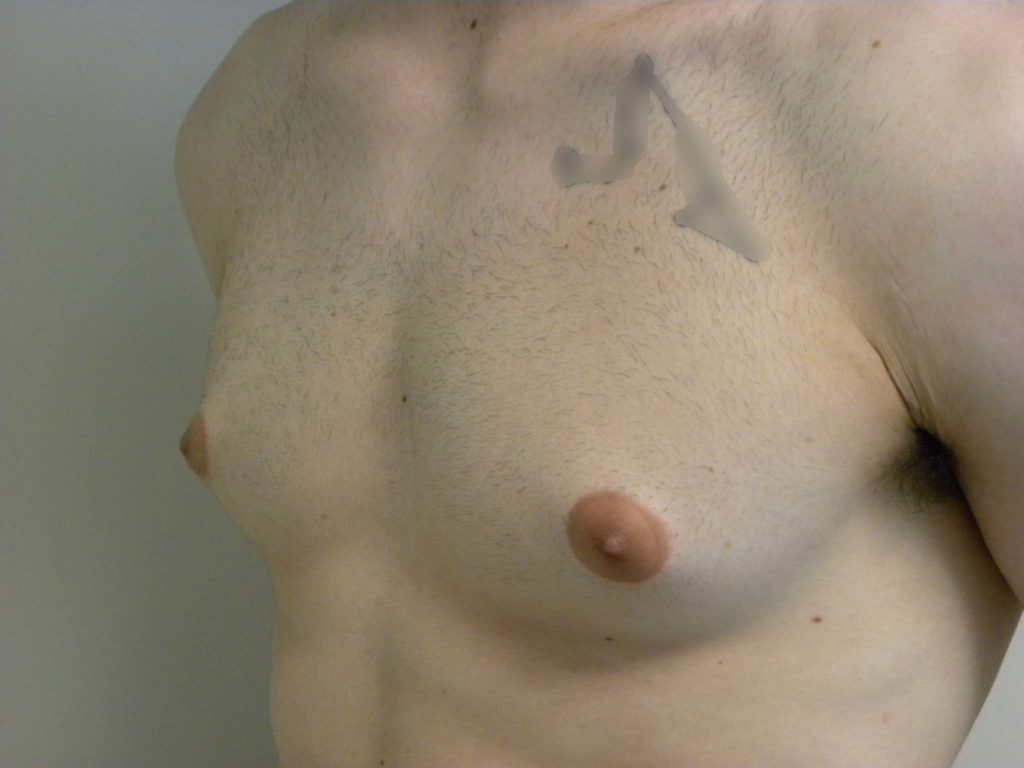 Gynecomastia Before and After Pictures in Miami, FL