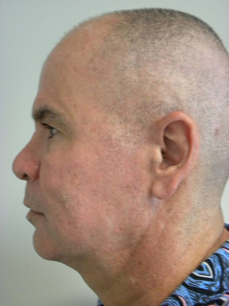Male Neck Lift Before and After Pictures Miami, FL