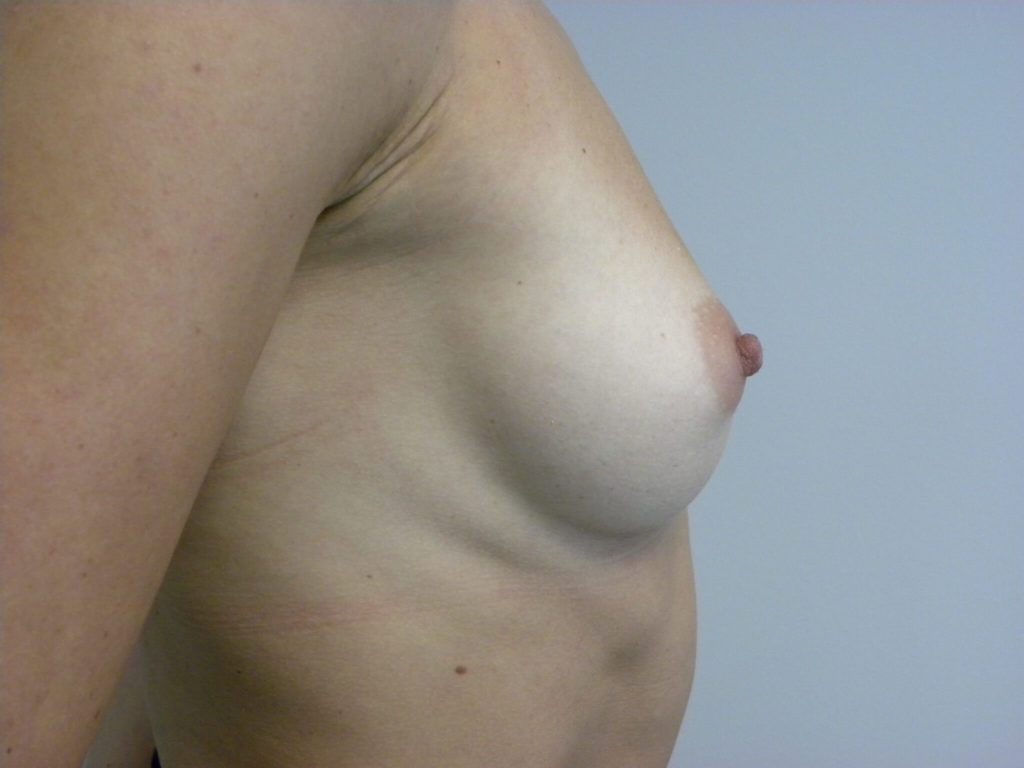 Breast Augmentation Before and After Pictures in Miami, FL