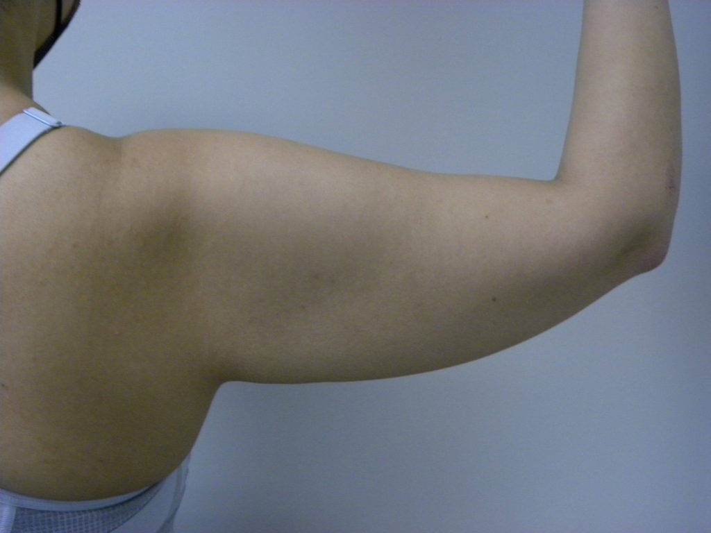 Arm Lift Before and After Pictures Miami, FL