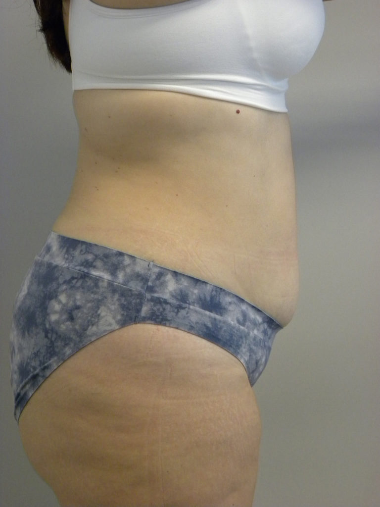 Tummy Tuck Before and After Pictures Miami, FL